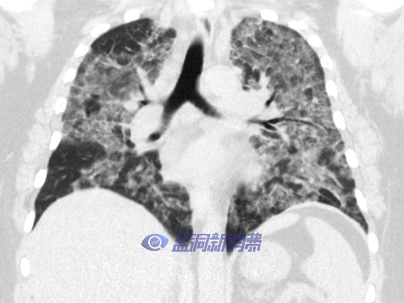 价值4000万美元的健康警告：Juul还面临14个州起诉